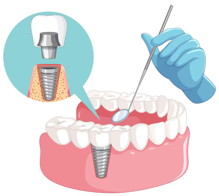 Dental Implants Edmonton