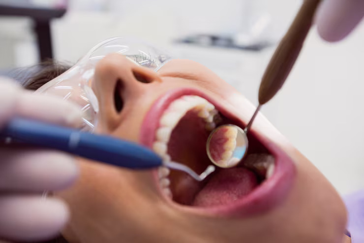 Root Canal Edmonton