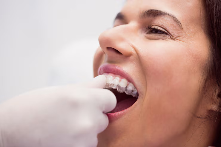 Invisalign Clear Aligners