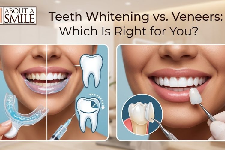 Teeth Whitening vs Veneers in Edmonton